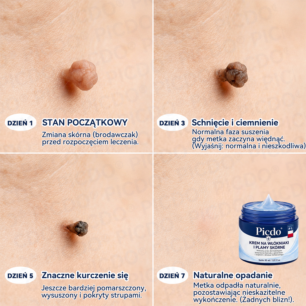 Picdo® 7-dniowy krem do usuwania narośli skórnych i plam pigmentacyjnych 🧴 (𝐒𝐜𝐡𝐦𝐞𝐫𝐳𝐟𝐫𝐞𝐢𝐞 𝐅𝐨𝐫𝐦𝐞𝐥 – 𝐨𝐡𝐧𝐞 𝐍𝐚𝐫𝐛𝐞𝐧) 🛡️
