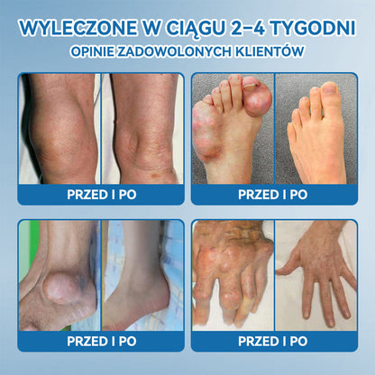 𝑃𝒊𝒄𝐝𝐨® B𝑷𝑪-157 Krem do leczenia stawów 🦴 𝐋𝐞𝐜𝐳𝐞𝐧𝐢𝐞 𝐳𝐚𝐩𝐚𝐥𝐞𝐧𝐢𝐚 𝐬𝐭𝐚𝐰ó𝐰,  𝒏𝒆𝒖𝒓𝒐𝒑𝒂𝒕𝒊𝒊, 𝒓𝒆𝒖𝒎𝒂𝒕𝒚𝒛𝒎𝒖,𝐮𝐫𝐚𝐳ó𝐰 𝐬𝐩𝐨𝐫𝐭𝐨𝐰𝐲𝐜𝐡 𝐢 𝐧𝐢𝐞 𝐭𝐲𝐥𝐤𝐨🍀