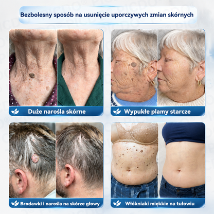 Picdo® 7-dniowy krem do usuwania narośli skórnych i plam pigmentacyjnych 🧴 (𝐒𝐜𝐡𝐦𝐞𝐫𝐳𝐟𝐫𝐞𝐢𝐞 𝐅𝐨𝐫𝐦𝐞𝐥 – 𝐨𝐡𝐧𝐞 𝐍𝐚𝐫𝐛𝐞𝐧) 🛡️