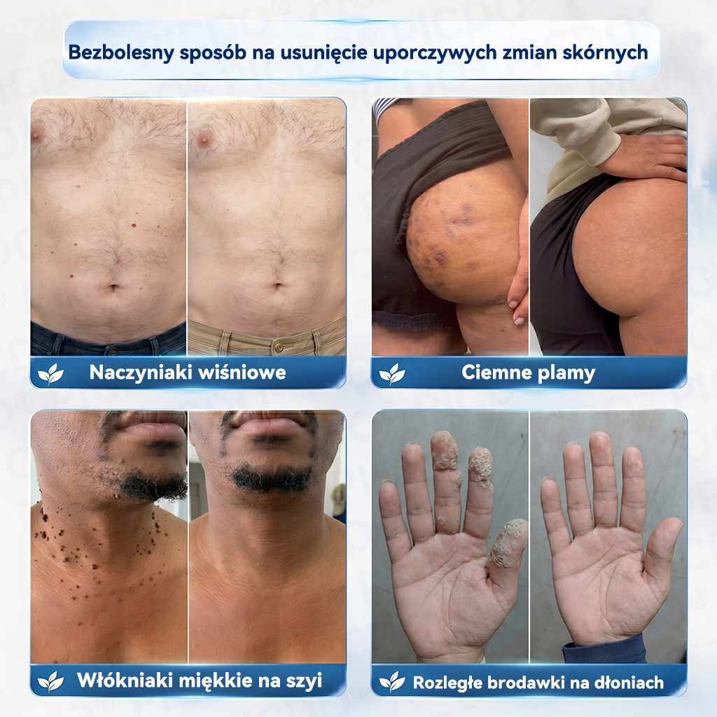 Picdo® 7-dniowy krem do usuwania narośli skórnych i plam pigmentacyjnych 🧴 (𝐒𝐜𝐡𝐦𝐞𝐫𝐳𝐟𝐫𝐞𝐢𝐞 𝐅𝐨𝐫𝐦𝐞𝐥 – 𝐨𝐡𝐧𝐞 𝐍𝐚𝐫𝐛𝐞𝐧) 🛡️