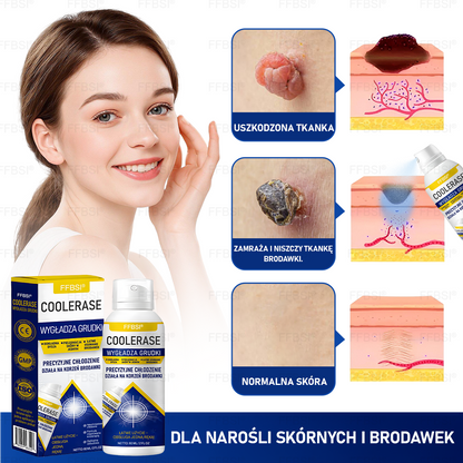 FFBSI®  CoolErase Spray do regeneracji skóry☘️(Brodawe, Pęcherze, Wypryski, Łuszczyca, Zmiany skórne, Trądzik, Skórne narośle, Blizny, Pieprzyki)