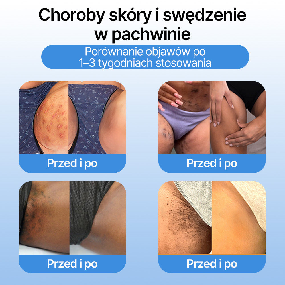 FFBSI®  CoolErase Spray do regeneracji skóry☘️(Brodawe, Pęcherze, Wypryski, Łuszczyca, Zmiany skórne, Trądzik, Skórne narośle, Blizny, Pieprzyki)