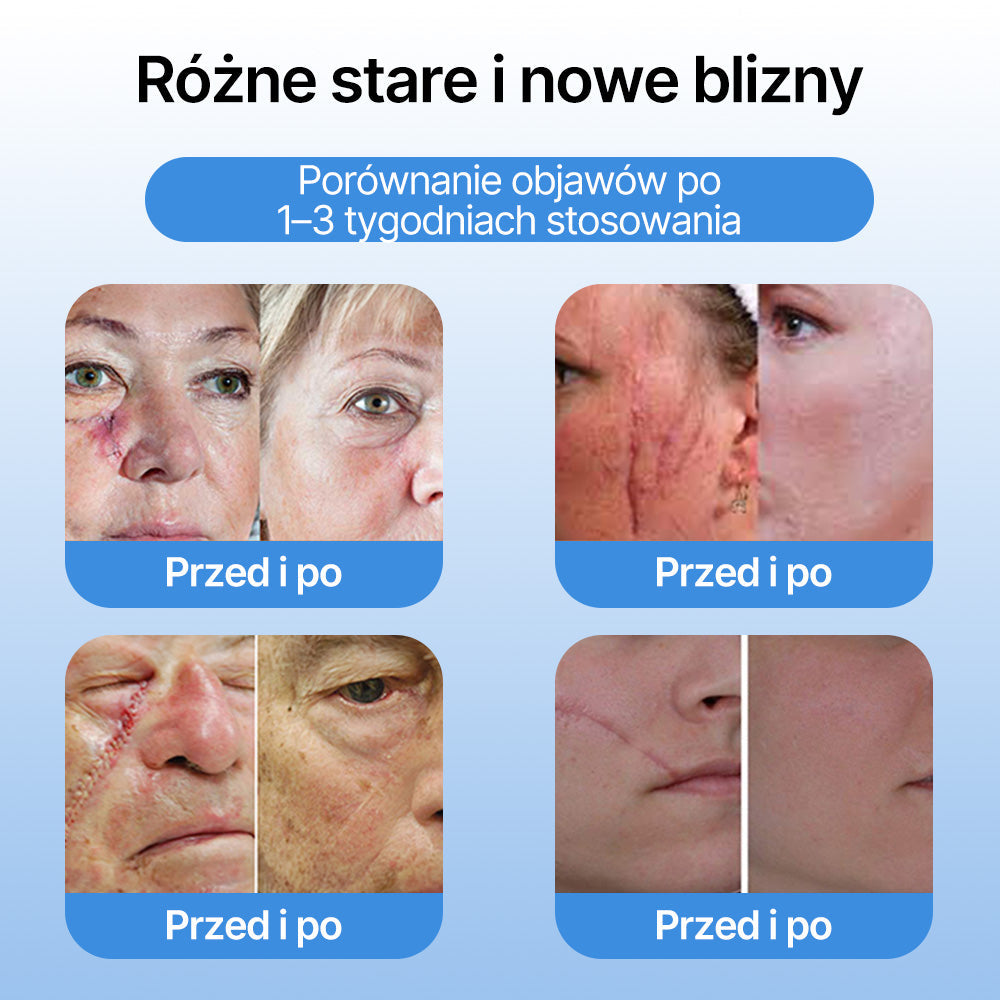 FFBSI®  CoolErase Spray do regeneracji skóry☘️(Brodawe, Pęcherze, Wypryski, Łuszczyca, Zmiany skórne, Trądzik, Skórne narośle, Blizny, Pieprzyki)