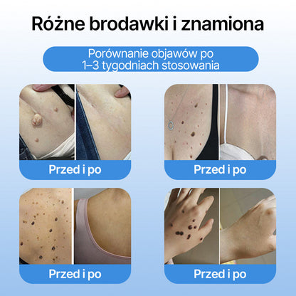 FFBSI®  CoolErase Spray do regeneracji skóry☘️(Brodawe, Pęcherze, Wypryski, Łuszczyca, Zmiany skórne, Trądzik, Skórne narośle, Blizny, Pieprzyki)