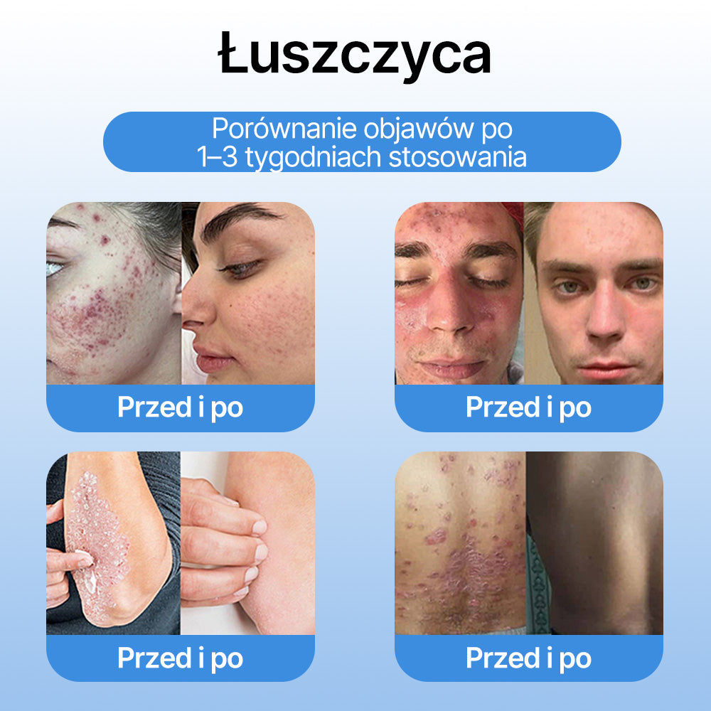 FFBSI®  CoolErase Spray do regeneracji skóry☘️(Brodawe, Pęcherze, Wypryski, Łuszczyca, Zmiany skórne, Trądzik, Skórne narośle, Blizny, Pieprzyki)