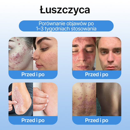 𝗹𝘂𝙠𝙢𝙡𝙘𝙖® 𝑪𝒐𝒐𝒍𝑬𝒓𝒂𝒔𝒆 𝑺𝒑𝒓𝒂𝒚 𝒅𝒐 𝒓𝒆𝒈𝒆𝒏𝒆𝒓𝒂𝒄𝒋𝒊 𝒔𝒌ó𝒓𝒚 🌿(𝑏𝑟𝑜𝑑𝑎𝑤𝑘𝑖, 𝑝ę𝑐ℎ𝑒𝑟𝑧𝑒, 𝑤𝑦𝑠𝑦𝑝𝑘𝑖, ł𝑢𝑠𝑧𝑐𝑧𝑦𝑐𝑎, 𝑝𝑟𝑜𝑏𝑙𝑒𝑚𝑦 𝑠𝑘ó𝑟𝑛𝑒, 𝑡𝑟ą𝑑𝑧𝑖𝑘, 𝑛𝑎𝑟𝑜ś𝑙𝑎 𝑠𝑘ó𝑟𝑛𝑒, 𝑏𝑙𝑖𝑧𝑛𝑦, 𝑧𝑛𝑎𝑚𝑖𝑜𝑛𝑎)🔥
