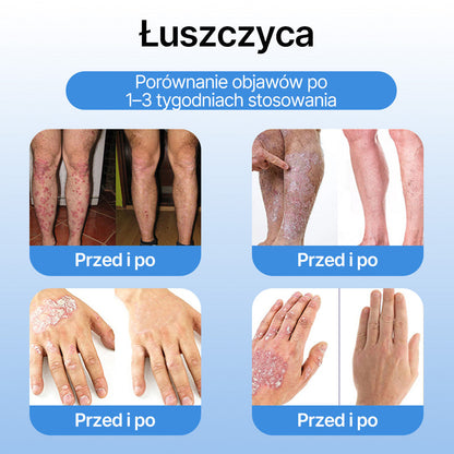 FFBSI®  CoolErase Spray do regeneracji skóry☘️(Brodawe, Pęcherze, Wypryski, Łuszczyca, Zmiany skórne, Trądzik, Skórne narośle, Blizny, Pieprzyki)