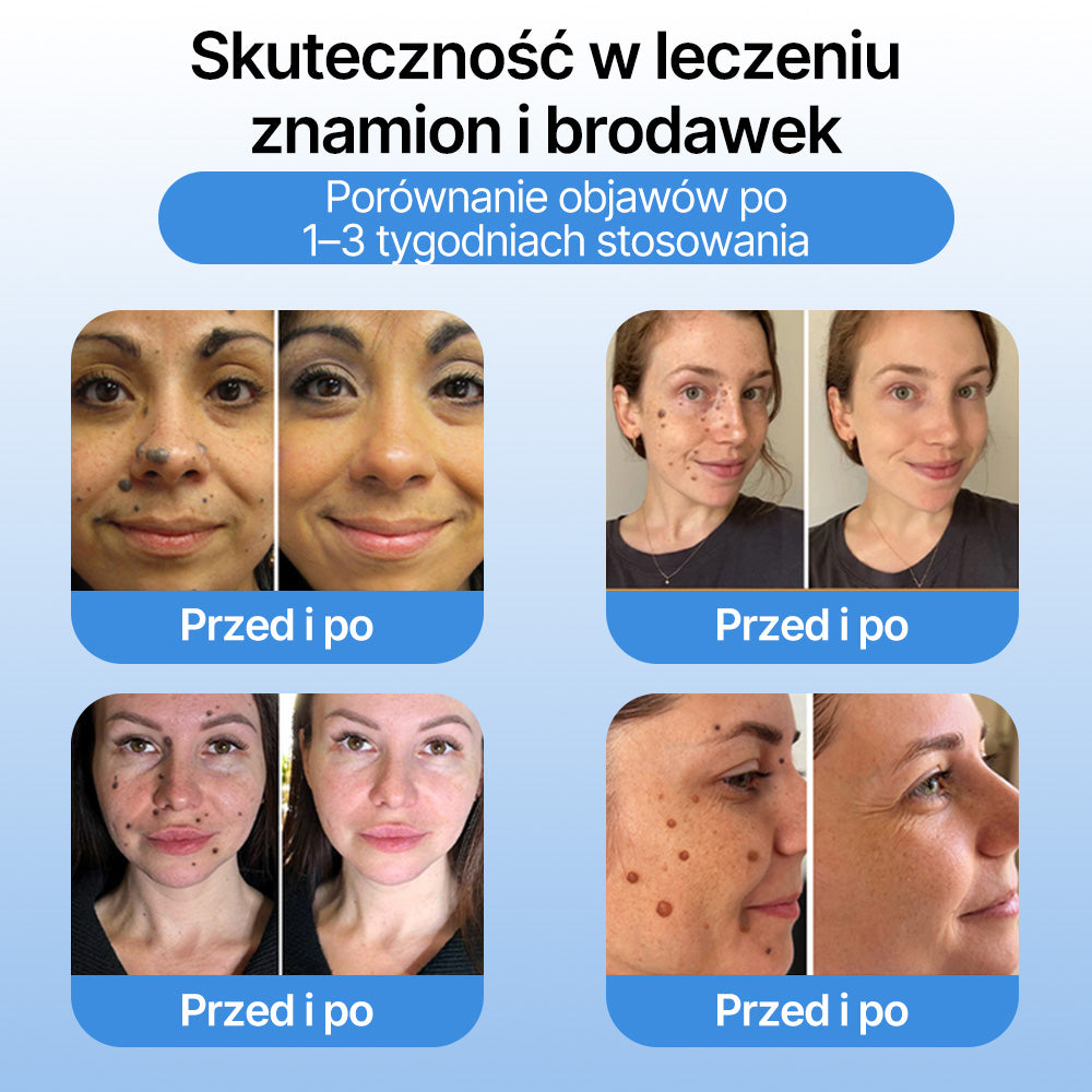 FFBSI®  CoolErase Spray do regeneracji skóry☘️(Brodawe, Pęcherze, Wypryski, Łuszczyca, Zmiany skórne, Trądzik, Skórne narośle, Blizny, Pieprzyki)