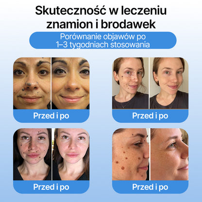 FFBSI®  CoolErase Spray do regeneracji skóry☘️(Brodawe, Pęcherze, Wypryski, Łuszczyca, Zmiany skórne, Trądzik, Skórne narośle, Blizny, Pieprzyki)