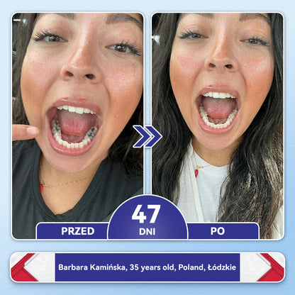 🦷 𝐆𝐥𝐢𝐦𝐦𝐞𝐫𝐥𝐲® 𝐓𝐢𝐝𝐞𝐠𝐥𝐮𝐬𝐢𝐛 Płatki Mikronakłuwające do Naprawy Zębów i Dziąseł | Zaawansowana Aktywacja Komórek Macierzystych – Strips do Naprawy Zębów 🛒