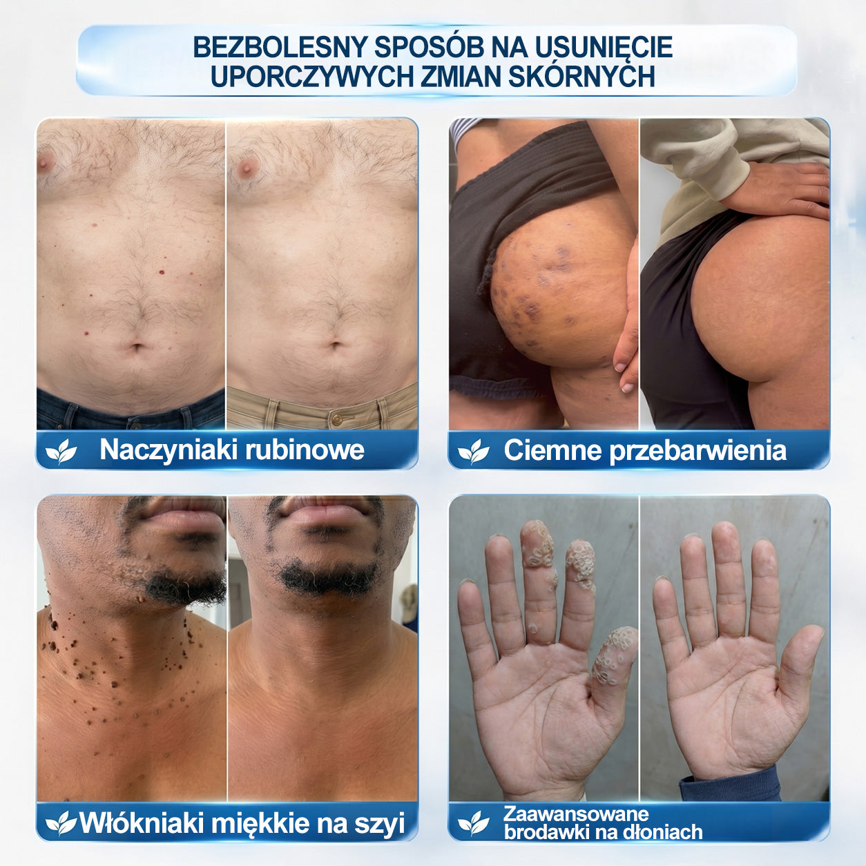 Oficjalny Sklep Markowy | ✅👩‍⚕️ 𝐏i𝐜𝐝o® 7-Dniowy 𝗧𝗮𝗴 & 𝗦𝗽𝗼𝐭 𝐄𝐫𝐚𝐬𝐞𝐫 (Bez bólu, Bez blizn – aplikator z kulką) 🌵