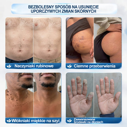 Oficjalny Sklep Markowy | ✅👩‍⚕️ 𝐏i𝐜𝐝o® 7-Dniowy 𝗧𝗮𝗴 & 𝗦𝗽𝗼𝐭 𝐄𝐫𝐚𝐬𝐞𝐫 (Bez bólu, Bez blizn – aplikator z kulką) 🌵