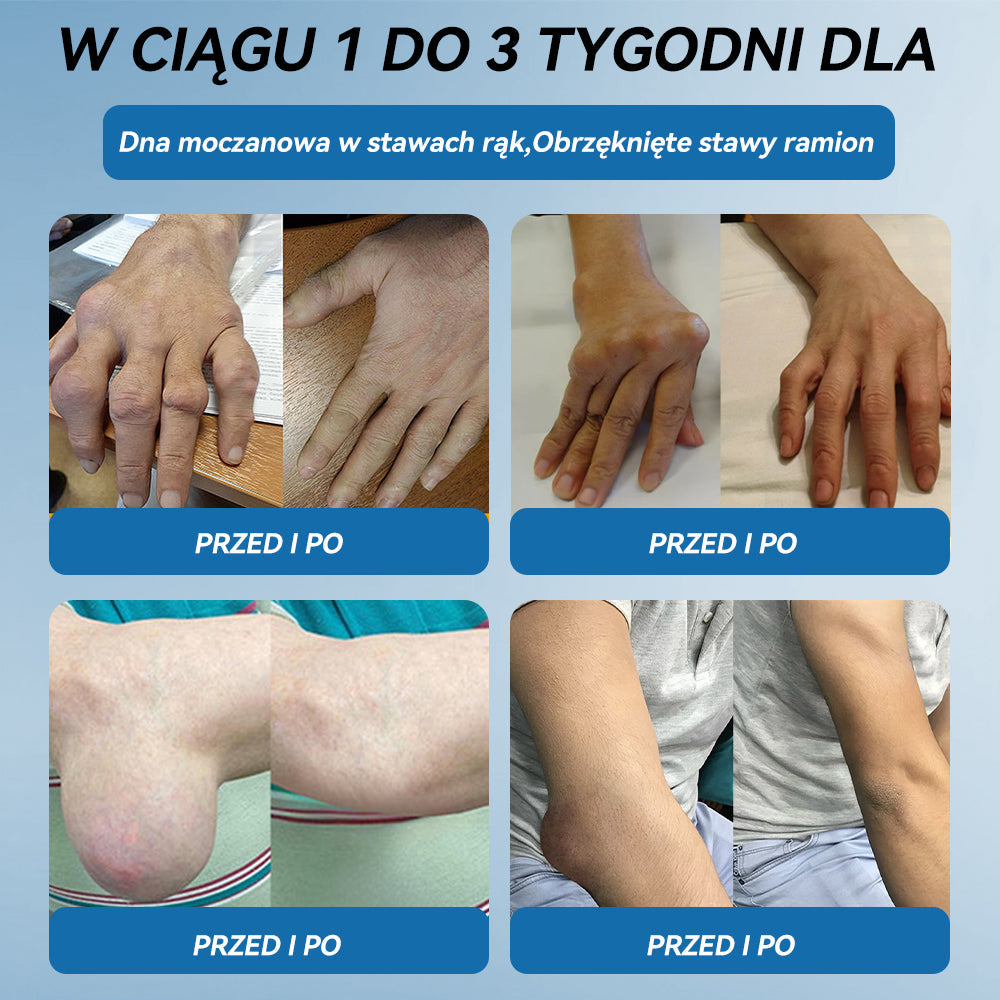 𝑃𝒊𝒄𝐝𝐨® B𝑷𝑪-157 Krem do leczenia stawów 🦴 𝐋𝐞𝐜𝐳𝐞𝐧𝐢𝐞 𝐳𝐚𝐩𝐚𝐥𝐞𝐧𝐢𝐚 𝐬𝐭𝐚𝐰ó𝐰,  𝒏𝒆𝒖𝒓𝒐𝒑𝒂𝒕𝒊𝒊, 𝒓𝒆𝒖𝒎𝒂𝒕𝒚𝒛𝒎𝒖,𝐮𝐫𝐚𝐳ó𝐰 𝐬𝐩𝐨𝐫𝐭𝐨𝐰𝐲𝐜𝐡 𝐢 𝐧𝐢𝐞 𝐭𝐲𝐥𝐤𝐨🍀