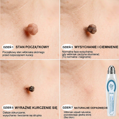 Oficjalny Sklep Markowy | ✅👩‍⚕️ 𝐏i𝐜𝐝o® 7-Dniowy 𝗧𝗮𝗴 & 𝗦𝗽𝗼𝐭 𝐄𝐫𝐚𝐬𝐞𝐫 (Bez bólu, Bez blizn – aplikator z kulką) 🌵