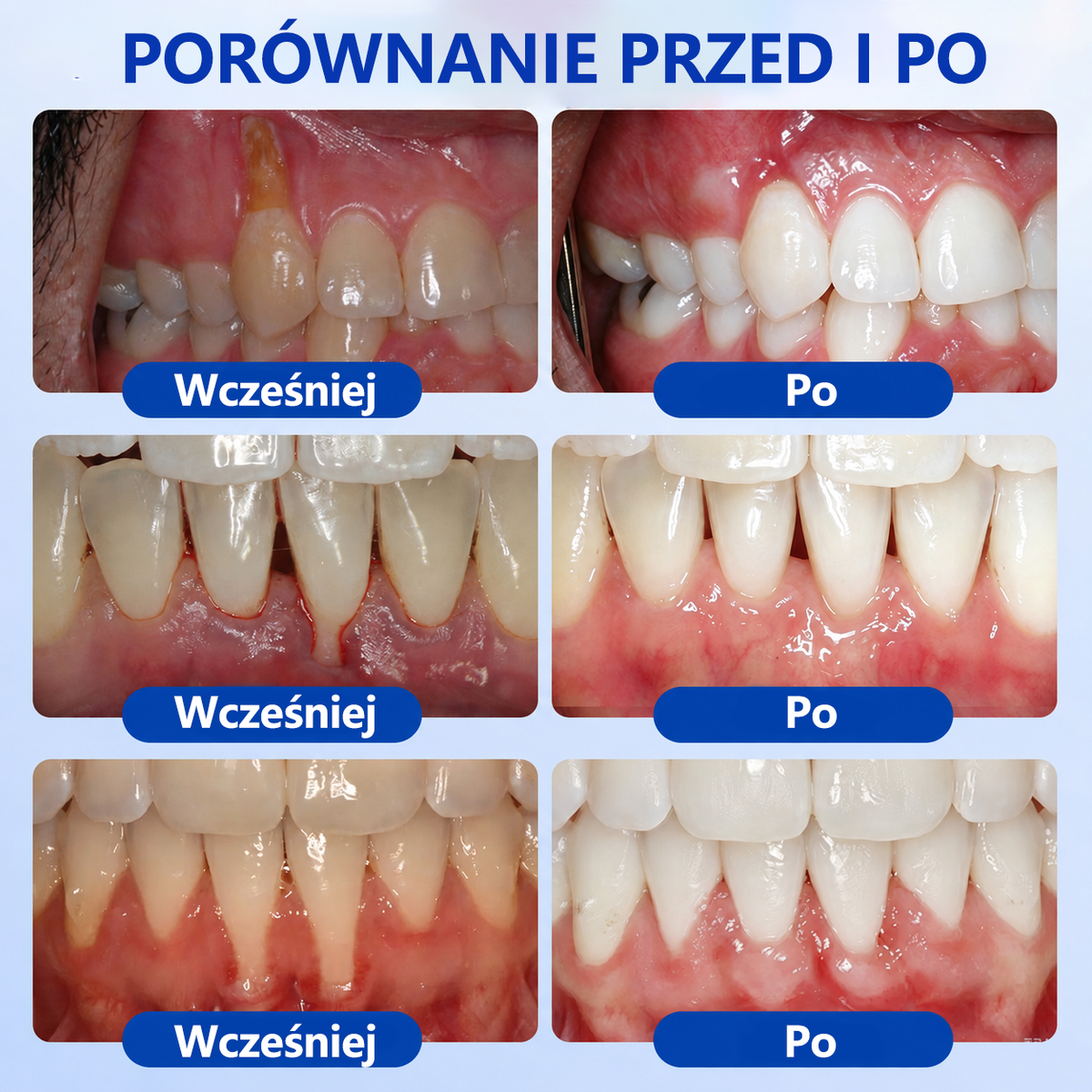 🇪🇺🏅🦷 Evolvion® GumRevive Żel do regeneracji przyzębia⚡